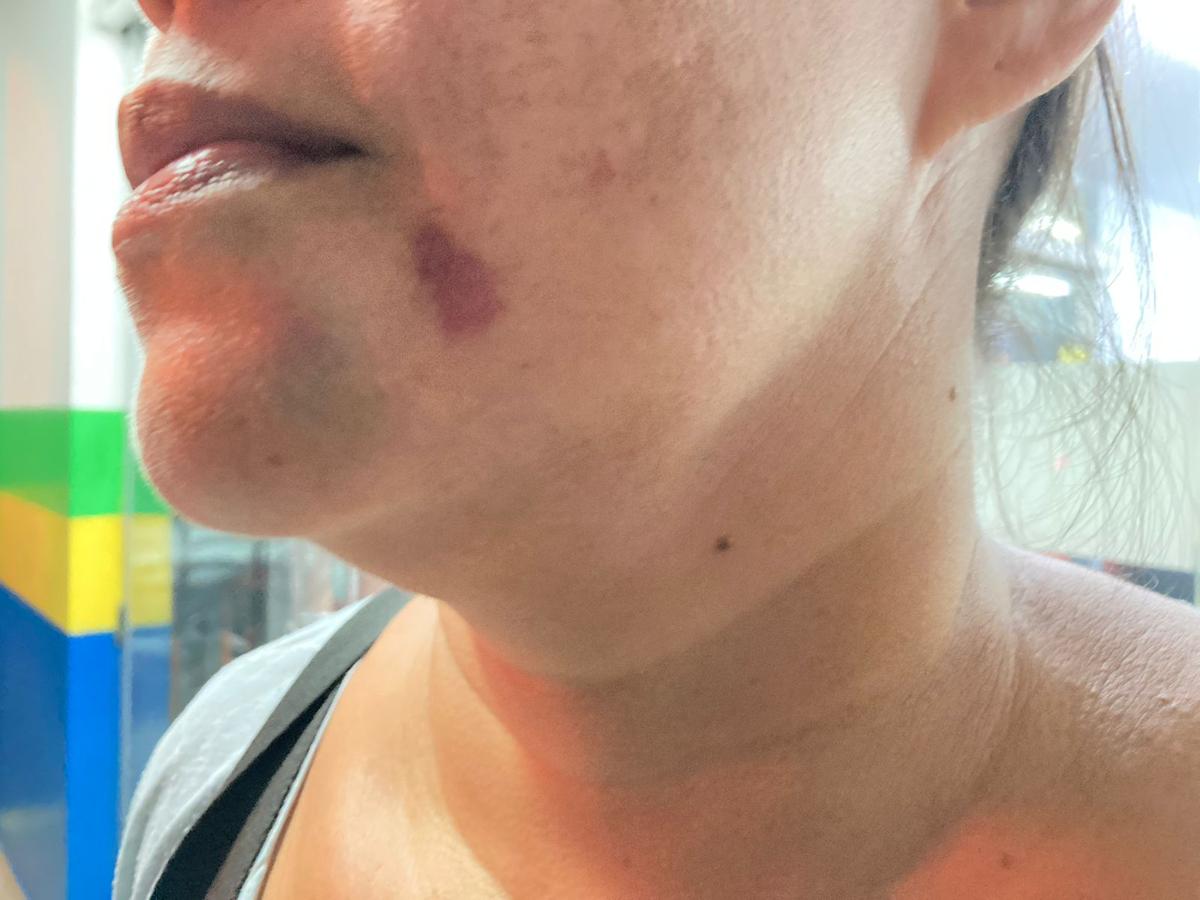 Babá ficou com marcas no rosto por conta das agressões (Foto: Wellyson Ferreira)