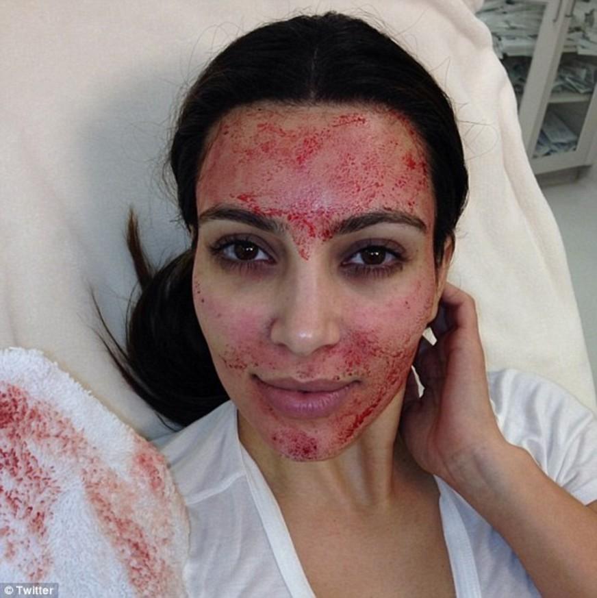 Kim Kardashian faz tratamento estético com o próprio sangue
