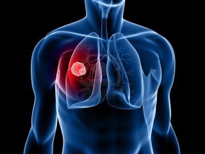 Exame pode aumentar longevidade de pessoas com câncer de pulmão