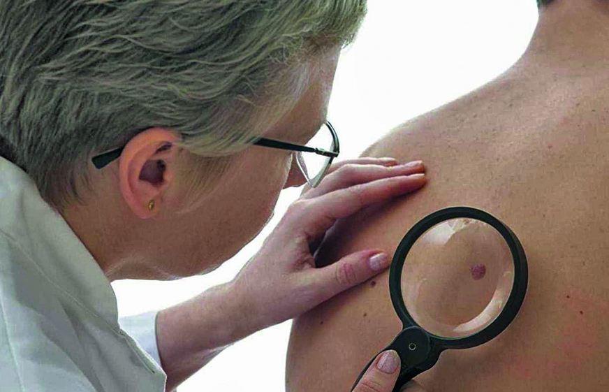 Detecção precoce é fundamental para o sucesso do tratamento do melanoma