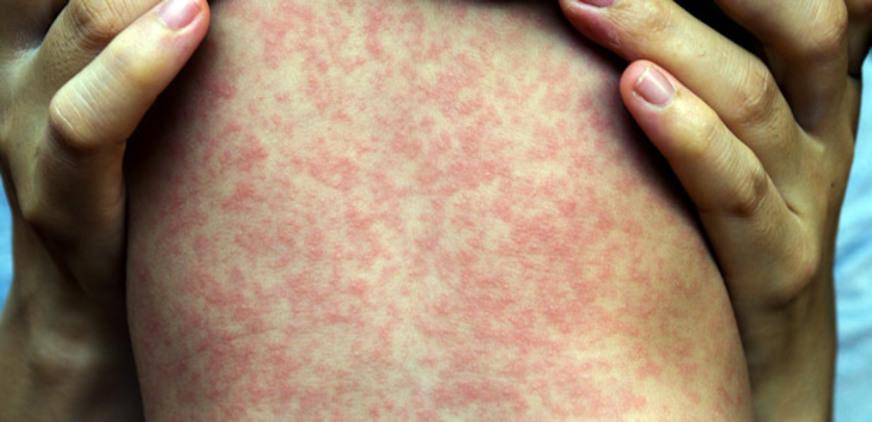 Sarampo: tire suas dúvidas sobre sintomas, prevenção e vacina contra doença