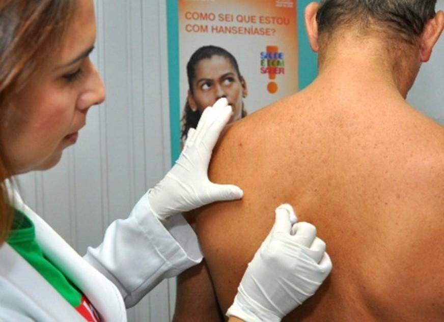 Hanseníase: desmonte e ocultação perigosa