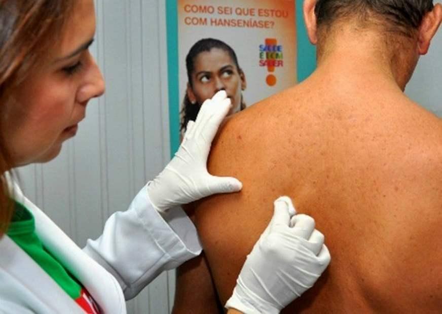Ministério quer retomada da produção de remédios para a hanseníase