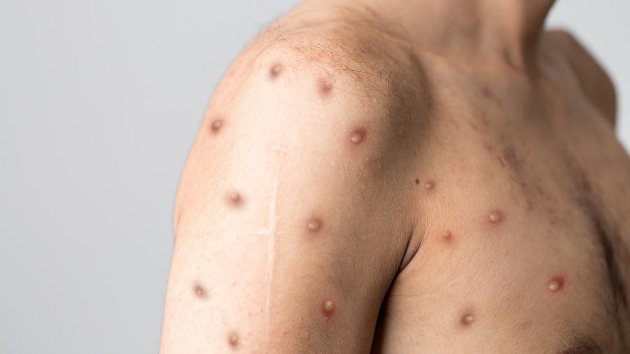 Primeiro caso de Monkeypox é confirmado no Amazonas