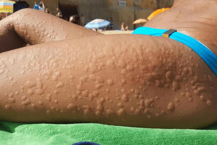 Quando o forte calor do verão amazônico causa alergia