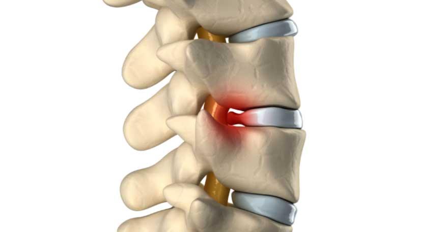 Qual o tratamento ideal para protusão discal?