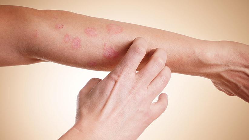 Amazonas possui 560 pessoas em tratamento contra leucemia