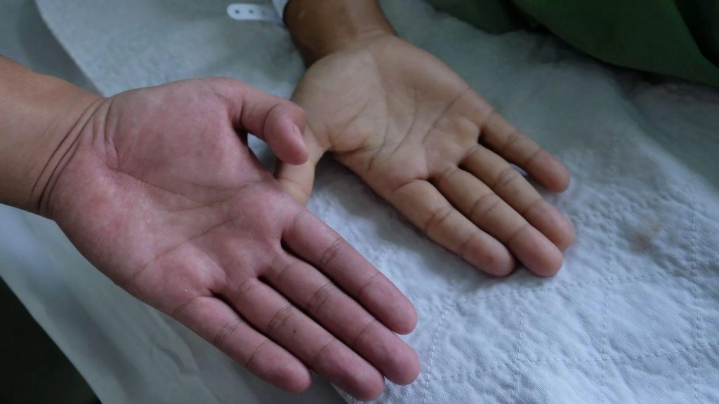 SUS passa a disponibilizar deferiprona para tratamento de pacientes com doença falciforme