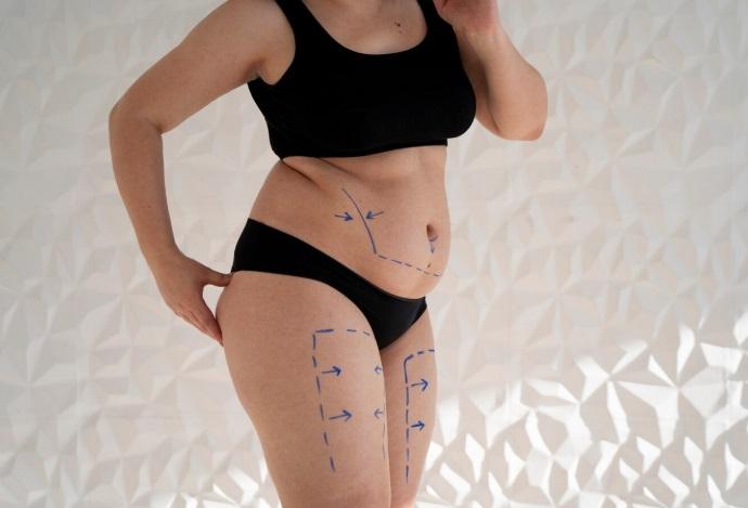 Como é Feita a Abdominoplastia: Passo a Passo Completo