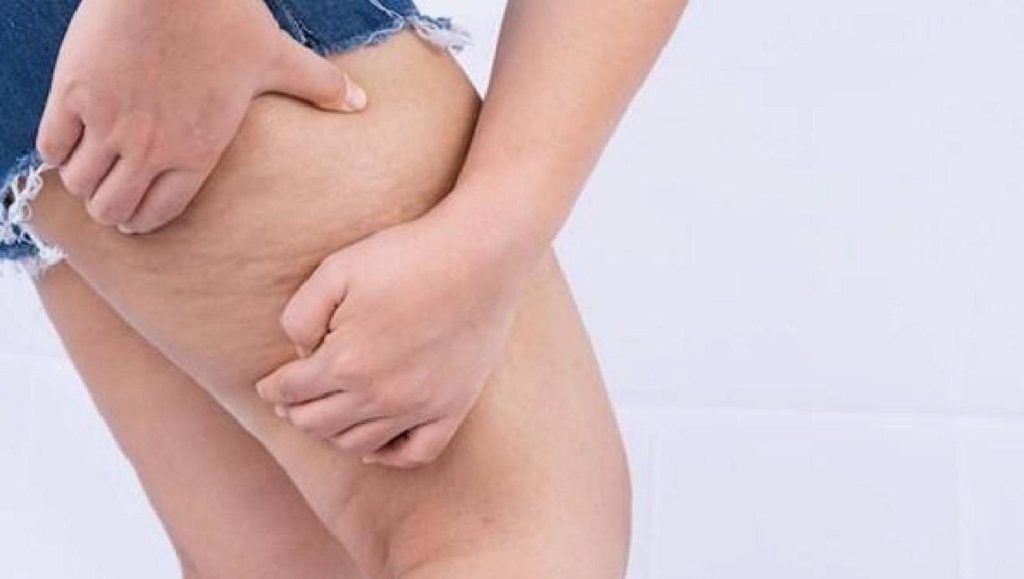 Lipedema: o diagnóstico que muda vidas