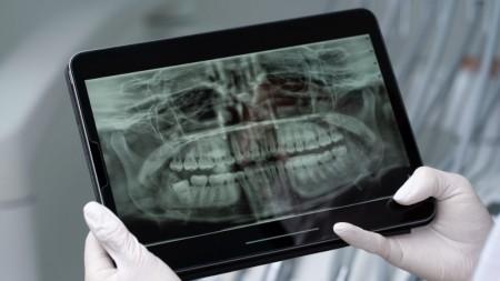 Saliva artificial ajuda a proteger os dentes de pacientes com câncer de cabeça e pescoço