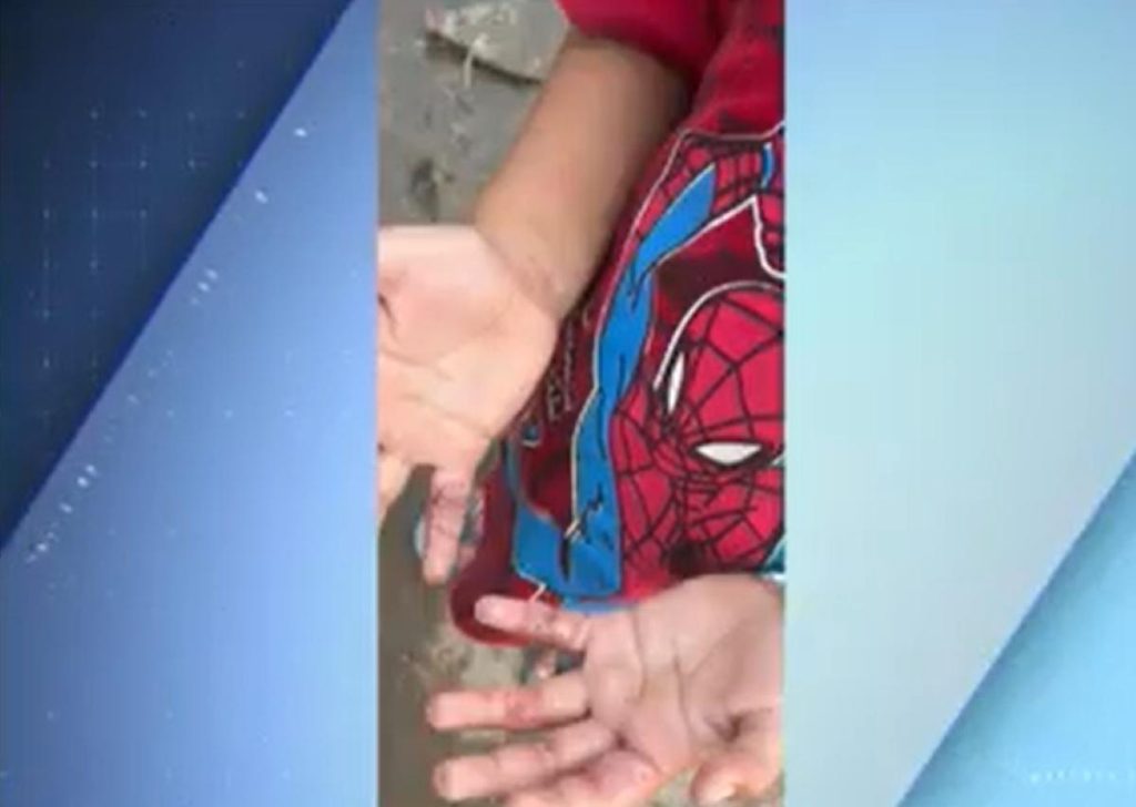 Criança de 5 anos com mãos queimadas é resgatada em Manaus